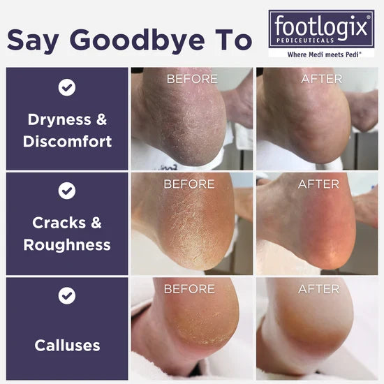 Footlogix Ultimate At-Home Foot Care Kit – Callus Softener & Foot File | 100ml