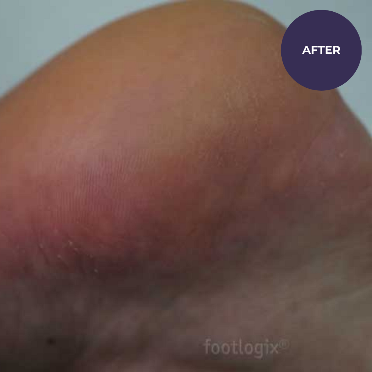 Footlogix DD Cream Mousse – Daily Defence Foot Moisturiser | 125ml