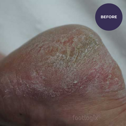 Footlogix DD Cream Mousse – Daily Defence Foot Moisturiser | 125ml